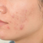 Dermatologia Acne, Cicatrici e Smagliature