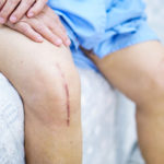 Acne, Cicatrici e Smagliature